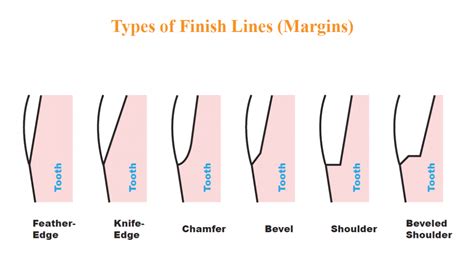 What Are The Types Of Finish Lines Margins Arklign