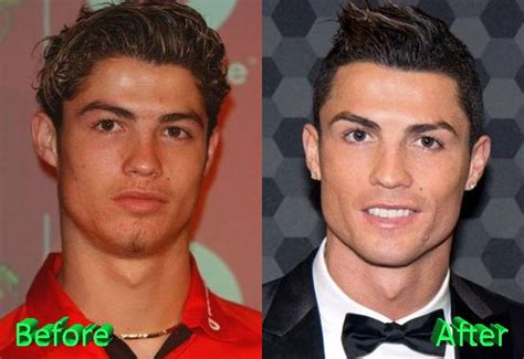 Cristiano Ronaldo Before Surgery Cristiano Ronaldo Plastic Surgery Celebrity Plastic