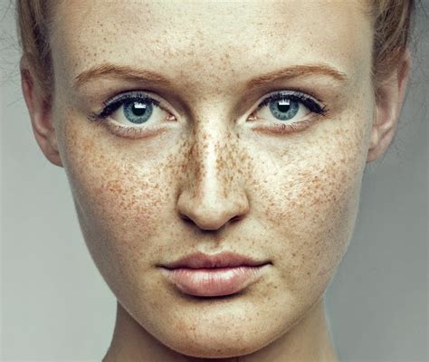 How To Get Freckle Free Skin Blog By Anum