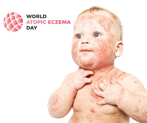Svjetski Dan Atopijskog Dermatitisa Rujna Atopika
