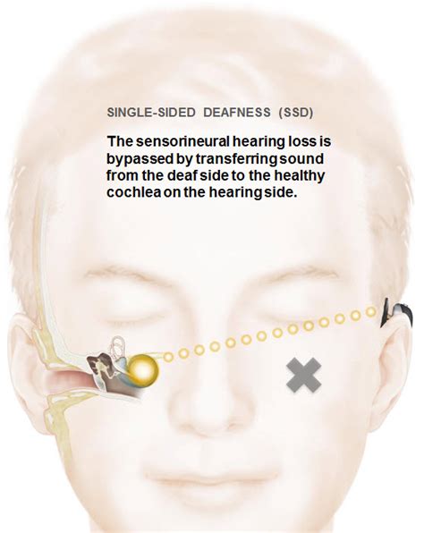 Sudden Unilateral Hearing Loss In One Ear Best Guide 2020