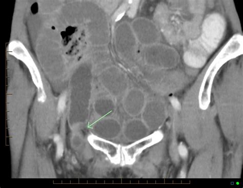 Incarcerated Femoral Hernia With Small Bowel Obstruction Image