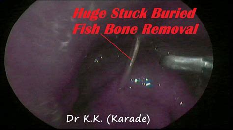 Huge Stuck Buried Fish Bone Removal From Throat Endoscopic Fish Bone