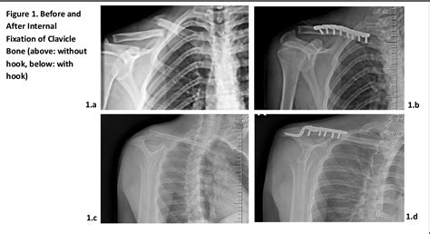 Figure 1 From Evaluation Of Complications In Clavicle Fractures