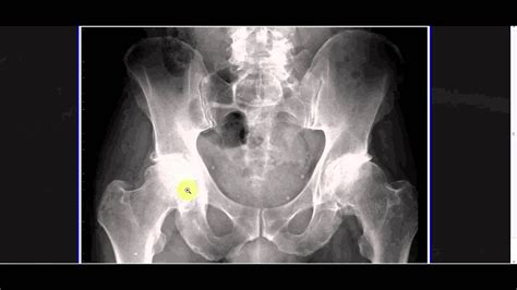 In order to help understand the conditions causing hip pain and their surgical treatment, it is important to first have it is a deep muscle that originates from the lower back and pelvis, and extends up to the inside surface of the upper part of the femur at the lesser trochanter. Hip Pain Xray Ordinary - Why Hip Flexor blogs