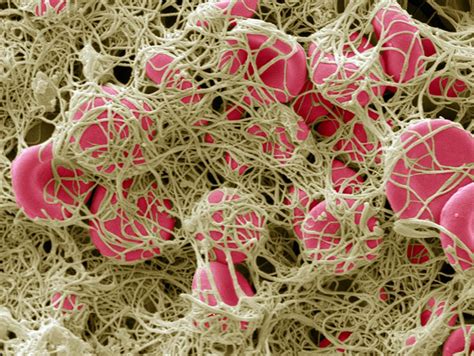 Coronavirus Blood Clot Mystery Intensifies