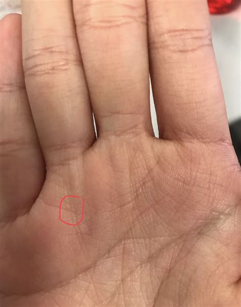 What Is This Bump On My Finger It Looks Bubbly Up Clo Vrogue Co