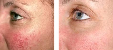 Facial Redness Skin Redness Treatment Melbourne Collins Cosmetic Clinic