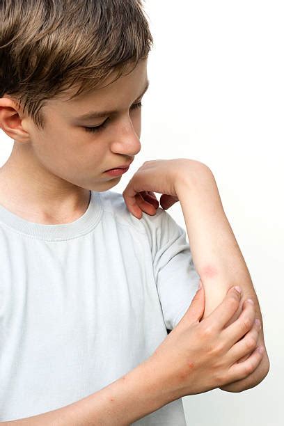 130 Bug Bite Insect Human Skin Allergy Stock Photos Pictures