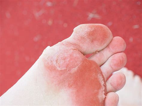 7 Important Facts About Hyperkeratosis A Skin Condition — Beatzpro