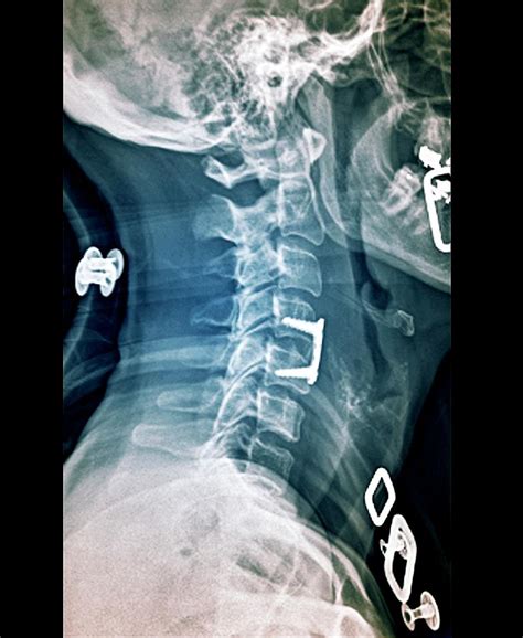 The disc often presses any disc in the spine can prolapse. Herniated Spinal Disc After Treatment Photograph by Zephyr