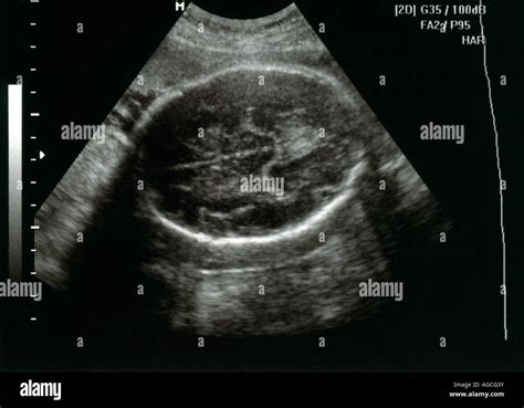 Fetal Ultrasound Showing The Fetus Head Stock Photo Alamy