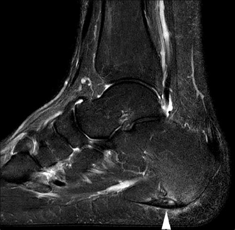 Magnetic resonance images of the foot may be digitized to quantify muscle architecture. Plantar fasciitis on MRI. A sagittal STIR image shows fusiform swelling... | Download Scientific ...