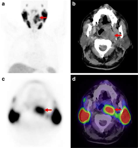 A Mip B Axial Ct C Axial Pet And D Axial Fused Petct Images From