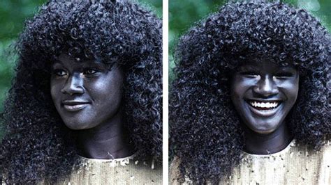 दुनिया के 5 सबसे अलग त्वचा वाले लोग 5 People With Unique Skin Colors