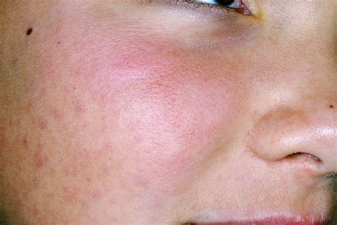 Mask Related Acne “maskne” And Other Facial Dermatoses The Bmj