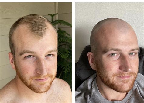 Pin By Ryan ST On Hair Bald Head With Beard Bald Head Man Before