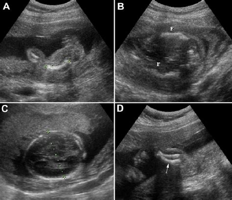 Prenatal Ultrasound At 22 Weeks Of Gestation Shows A Curved Femur