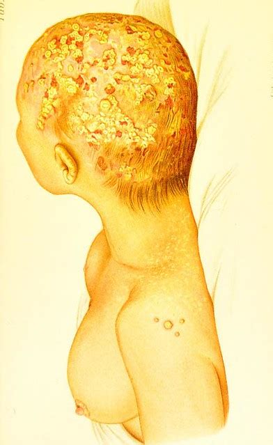 This Image Is Taken From Atlas Of Diseases Of The Skin El Flickr