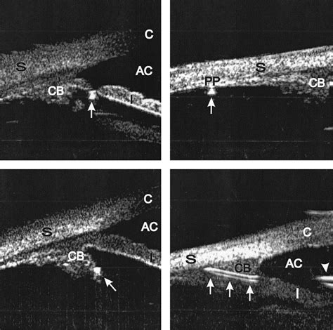 Ultrasound Biomicroscopy In Uveitis Glaucoma Hyphema Syndrome