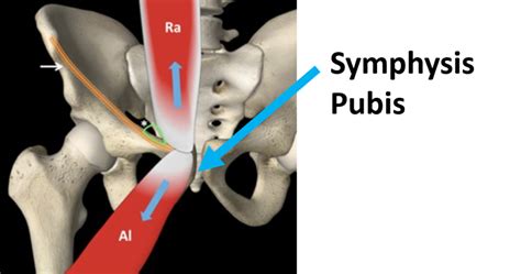 Groin Muscle Anatomy Osteitis Pubis A Likely Cause Of Groin Pain Porn