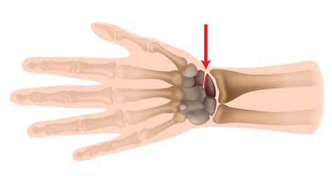 Scaphoid Fracture Symptoms Causes And Treatment