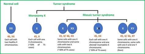 Monosomy Turner Syndrome