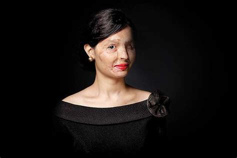 Reshma Qureshi The Acid Attack Survivor Inspiring Millions
