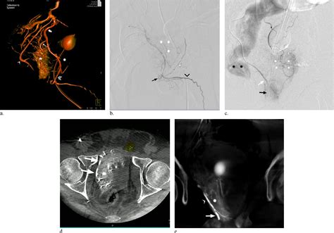 Prostatic Artery Embolization And The Accessory Pudendal Artery Journal Of Vascular And