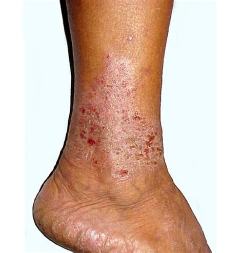 Venous Stasis Ulcer Treatment Pictures Causes Symptoms