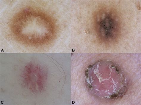 The Dermoscopic Variability Of Dermatofibromas Journal Of The