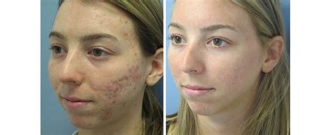 Fraxel Laser Before And After Acne Scars Change Comin
