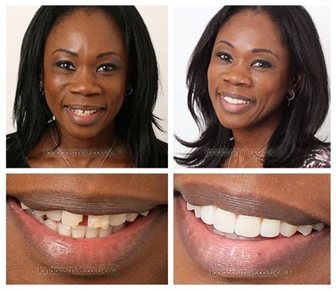 Front Teeth Veneers Before And After Teethwalls