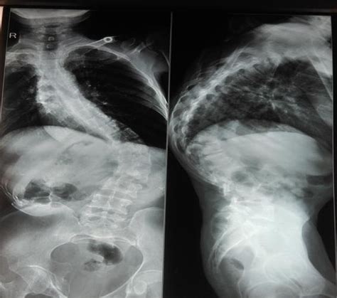 X Ray Spine Showing Scoliosis And Kyphosis The Risks Of Anaesthetic