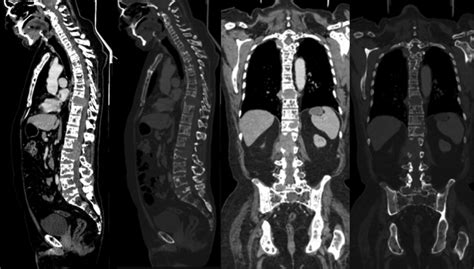 A D Computed Tomography Examination Of Bone Structures From The