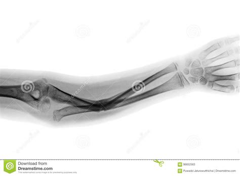 Film X Ray Forearm Ap Show Fracture Shaft Of Ulnar Bone