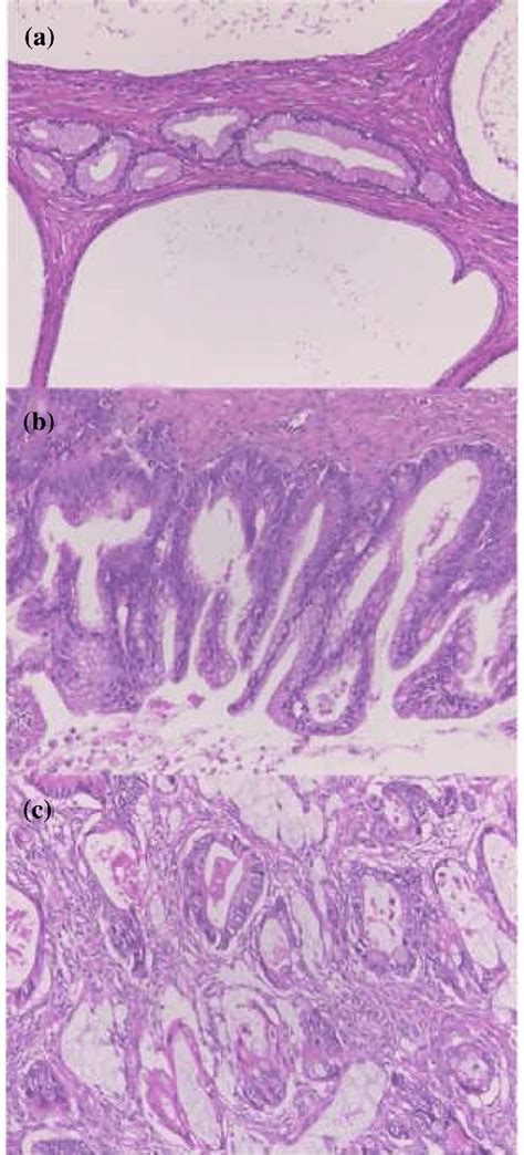 Histological Appearance Of The Mucinous Ovarian Tumors A Hematoxylin