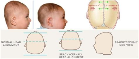 Brachycephaly Causes Symptoms And Treatment Hoool Health And Wellness