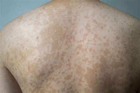 Everything You Need To Know About Tinea Versicolor Skin And Cancer