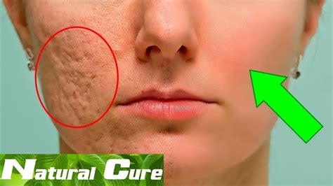 Natural Cure How To Prevent And Fade Acne Scars Fast Youtube