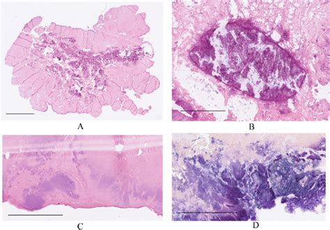 Histology A D Shows Devitalized Tissue With Central Areas With