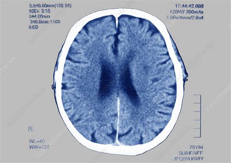 Brain Scan Stock Image C0129758 Science Photo Library
