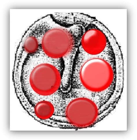 Schematic Picture Of Bullous Myringitis Drawn With Open Source Inkscape