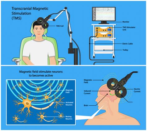 Tms Clinic Transcranial Magnetic Stimulation Therapy