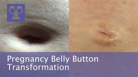 Belly Button At 4 Months Pregnant Pregnantbelly
