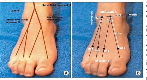 Figure 2 From Nerve Conduction Study Of The Superficial Peroneal