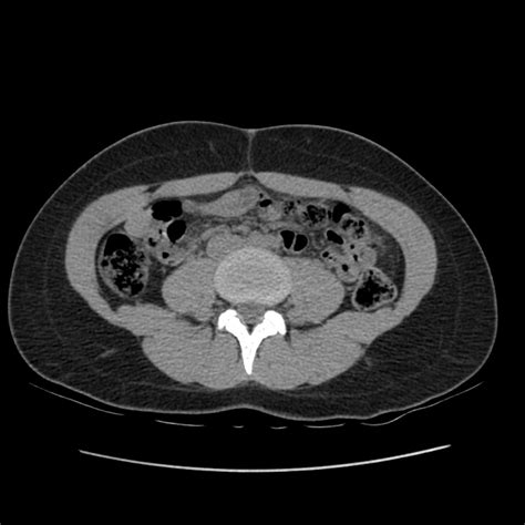 Normal CT Abdomen And Pelvis Triphasic Protocol Image Radiopaedia Org
