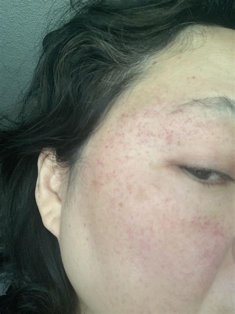 Petechiae All Over Face After Surgery Rdermatologyquestions