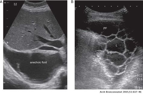 Obliteration of left costophrenic angle with a wide pleural based dome shaped opacity projecting into. Management of parapneumonic pleural effusion in adults | Archivos de Bronconeumología (English ...