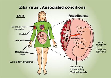 Cureus A Comprehensive Review Of The Manifestations And Pathogenesis Of Zika Virus In Neonates